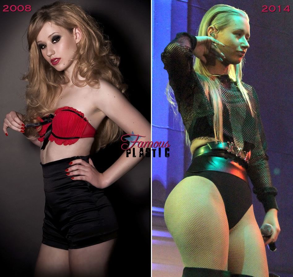 iggy-azalea-butt-shots-before-after-plastic-surgery