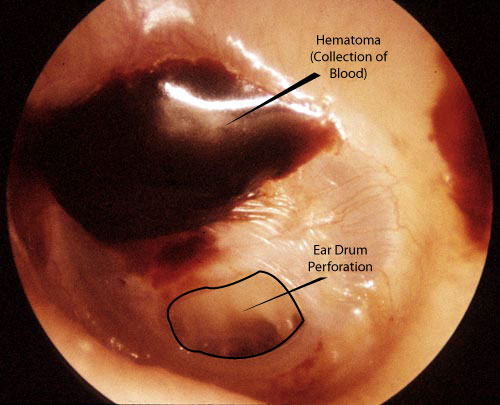 Perforated ear drum caused by an ear slap